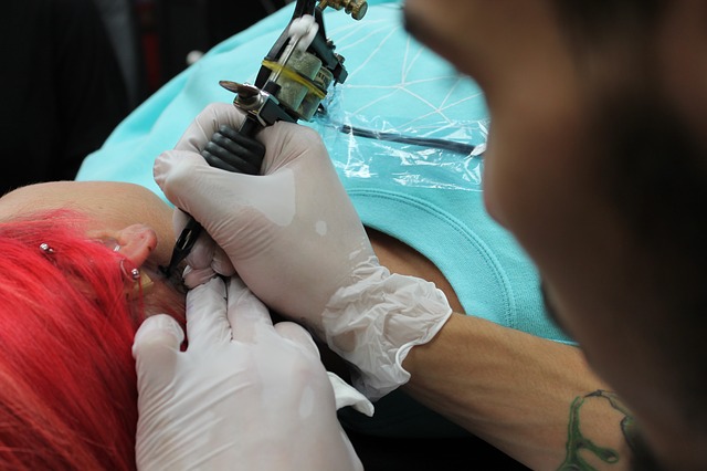 Does laser tattoo removal cause keloids - Wound Care Society