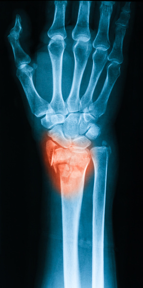 What Is the Most Common Fracture in Children? - Wound Care Society